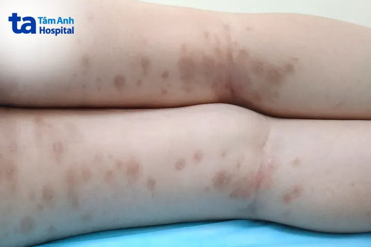 Thuốc sinh học: thêm cánh cửa cho người vảy nến - Ảnh 2. Thuốc sinh học: thêm cánh cửa cho người vảy nến - Ảnh 2.