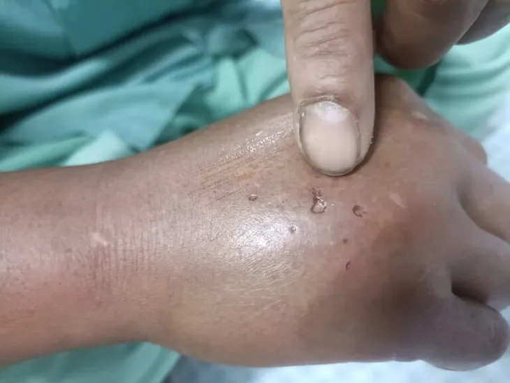 Chơi ở sân nhà, 2 bé gái sinh đôi bị rắn hổ mang cắn - Ảnh 1.