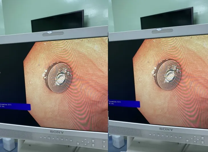 Cảnh báo trẻ nuốt dị vật nguy hiểm - Ảnh 2. Cảnh báo trẻ nuốt dị vật nguy hiểm - Ảnh 2.