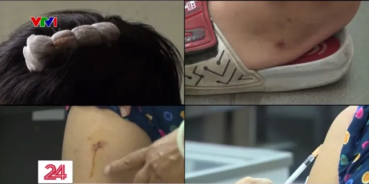 Nhiều trường hợp bệnh nhi nguy kịch vì bệnh dại - Ảnh 3. Nhiều trường hợp bệnh nhi nguy kịch vì bệnh dại - Ảnh 3.