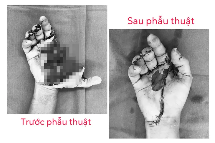 Một bệnh viện ở Hà Nội tiếp nhận 15 ca tai nạn pháo nổ trong 1 ngày - Ảnh 1. Một bệnh viện ở Hà Nội tiếp nhận 15 ca tai nạn pháo nổ trong 1 ngày - Ảnh 1.