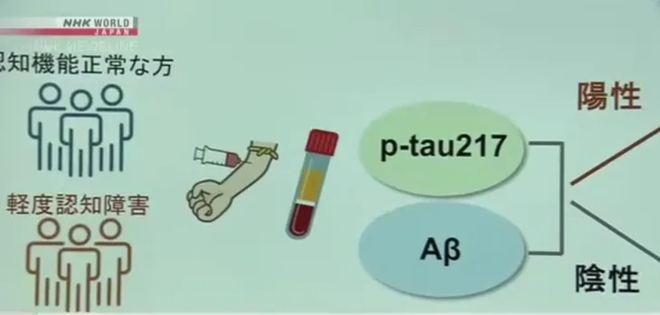 Xét nghiệm máu có thể phát hiện bệnh Alzheimer ở giai đoạn sớm - Ảnh 1. Xét nghiệm máu có thể phát hiện bệnh Alzheimer ở giai đoạn sớm - Ảnh 1.