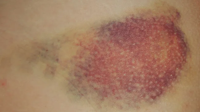 Cách phát hiện sớm biến chứng sau khi phẫu thuật nâng ngực tại nhà - Ảnh 4. Cách phát hiện sớm biến chứng sau khi phẫu thuật nâng ngực tại nhà - Ảnh 4.