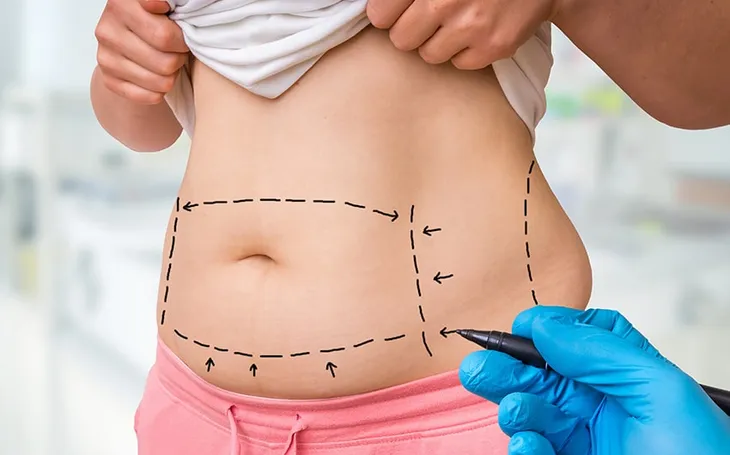 Một số điều cần biết khi hút mỡ để tránh biến chứng - Ảnh 1. Một số điều cần biết khi hút mỡ để tránh biến chứng - Ảnh 1.