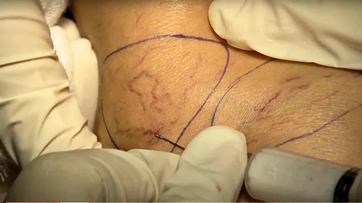 Những bước tiến mới trong việc điều trị suy giãn tĩnh mạch hiện nay - Ảnh 3. Những bước tiến mới trong việc điều trị suy giãn tĩnh mạch hiện nay - Ảnh 3.