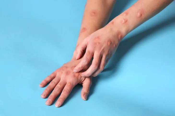 Anh phát hiện thêm 2 trường hợp nhiễm biến thể đậu mùa khỉ mới - Ảnh 1. Anh phát hiện thêm 2 trường hợp nhiễm biến thể đậu mùa khỉ mới - Ảnh 1.