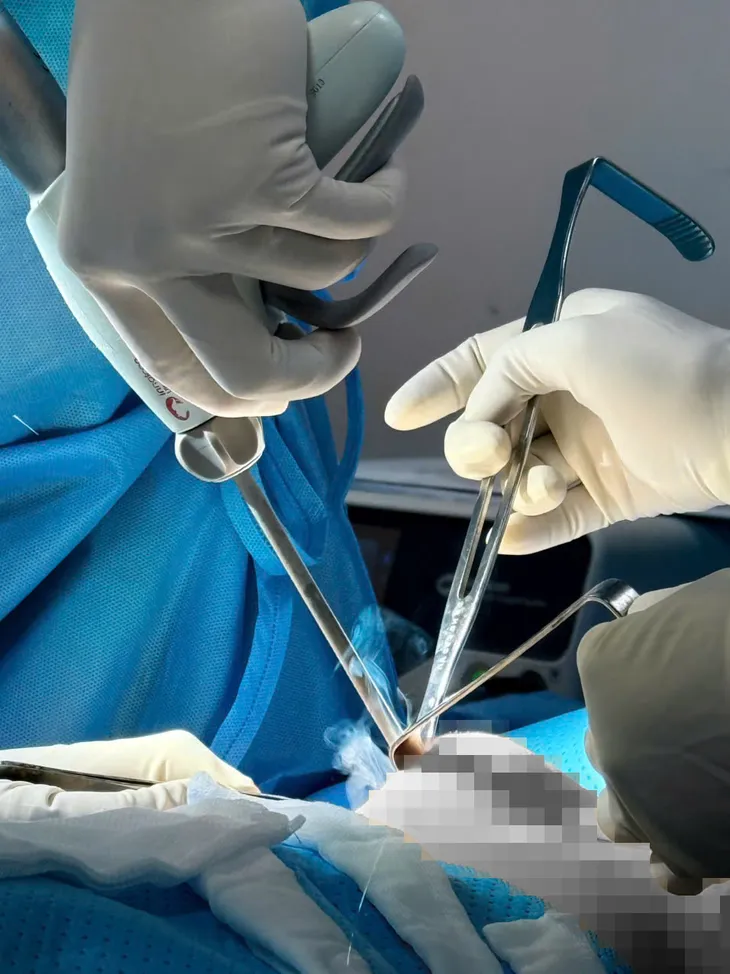 Co thắt bao xơ tái phát là gì? - Ảnh 5.