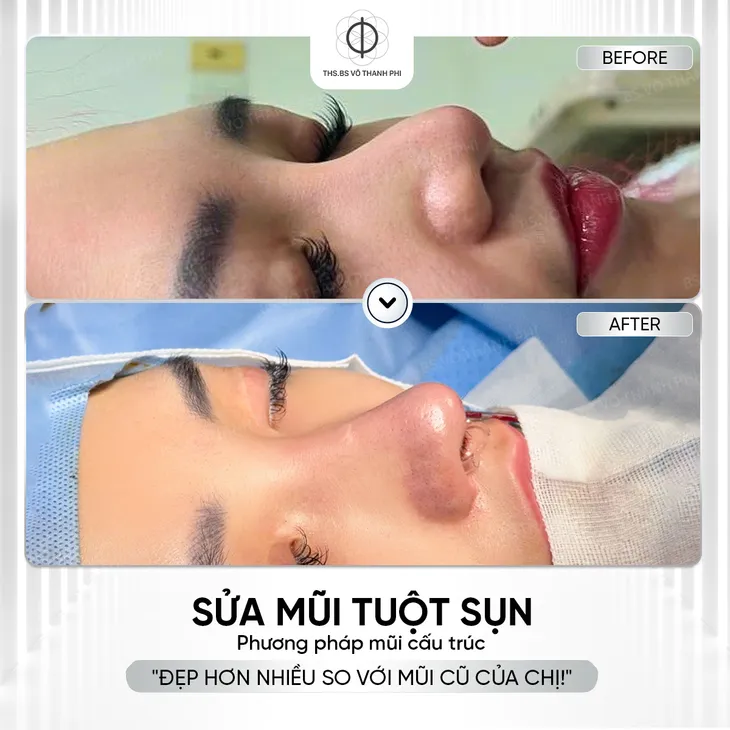 Mũi hỏng sau nâng: Khi nào nên sửa, khi nào nên chờ? - Ảnh 3.