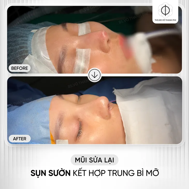 Mũi hỏng sau nâng: Khi nào nên sửa, khi nào nên chờ? - Ảnh 4.