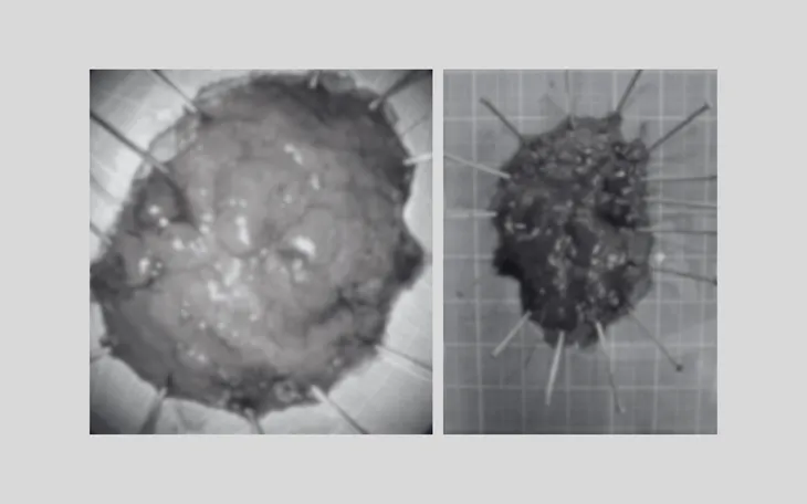2 polyp kích thước lớn được loại bỏ trong quá trình nội soi can thiệp/Ảnh VTV 2 polyp kích thước lớn được loại bỏ trong quá trình nội soi can thiệp/Ảnh VTV