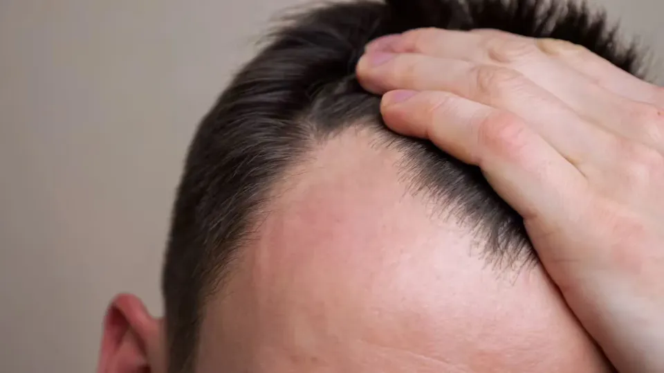 Những loại đồ uống phổ biến này có thể gây rụng tóc ở nam giới