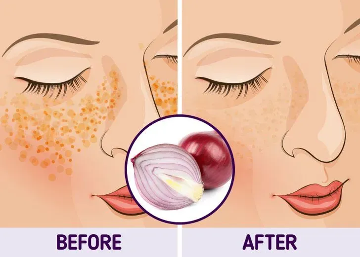 Bí quyết đánh bay thâm nám tự nhiên
