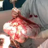 Doctors remove 35kg tumor from woman’s ovary