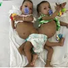 Conjoined twins successfully separated