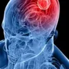 New brain tumor treatment