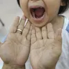 Hand, foot and mouth disease outbreak in Malaysia