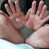 Hand- foot- and mouth disease cases increase