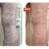 Foreign Tourist Recovers After Varicose Vein Treatment at Dr.Vein