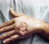 Thái Lan cảnh báo bệnh nhiễm ký sinh trùng Leishmania gây tử vong