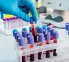 Hơn 40% người Việt có cholesterol máu cao
