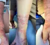 Viêm da tiếp xúc do sứa biển - Mối nguy tiềm ẩn mùa du lịch hè