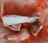 Ngộ độc chì sau khi bôi và uống "thuốc cam" 7 ngày