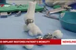 3D implant restores patient's mobility