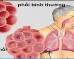 Phòng bệnh viêm phổi ở người cao tuổi