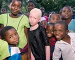 Người mắc bạch tạng ở Malawi có nguy cơ tuyệt chủng