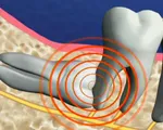 Răng khôn - khôn hay dại?