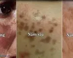 Điều trị nám da ở phụ nữ