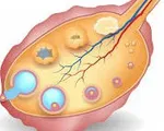 Siêu âm theo dõi nang noãn trong điều trị vô sinh