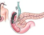 Các triệu chứng dễ bỏ qua của ung thư tụy