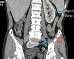 Đưa quả thận 'đi lạc' 61 năm về đúng vị trí