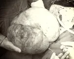 Phẫu thuật khối u buồng trứng nặng 6,2kg