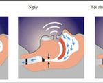 Phát hiện mới ngăn chặn nguy cơ mắc chứng mất trí