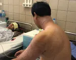 Du khách nhập viện vì bị sứa đốt