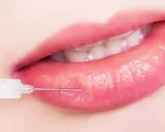 Sự thật ít ai biết của việc tiêm filler môi làm đẹp