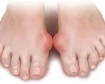 Những điều người bệnh gout cần đặc biệt lưu ý