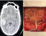 Xuyên đêm cấp cứu bệnh nhân lún xương sọ, chảy máu não vì đá bóng