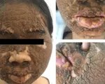 Tổn thương da nghi&ecirc;m trọng do d&ugrave;ng thuốc trắng da kh&ocirc;ng r&otilde; nguồn gốc