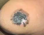 Từ một đốm đen nhỏ ở gan bàn chân, người đàn ông vào viện phát hiện ung thư da