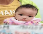 Ghép xương hàm, xương ổ răng điều trị dị tật bẩm sinh khe hở môi, vòm miệng