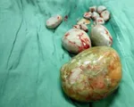 Lấy viên sỏi to như trứng vịt trong bàng quang bệnh nhân cao tuổi