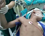 Né viên gạch khỏi rơi vào đầu, nam thanh niên trượt ngã bị thanh sắt xuyên thấu từ nách lên vai