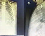 Hóc dị vật ở trẻ nhỏ - Mối nguy hiểm cảnh báo các bậc phụ huynh