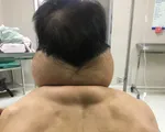 'Biến' thành... người khổng lồ sau nhiều năm nghiện rượu