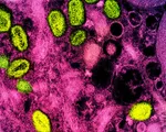 Bệnh đậu mùa khỉ được đổi tên thành 'mpox'
