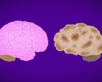 Người ngoài 30 tuổi cần ngăn ngừa bệnh Alzheimer khi có những dấu hiệu cảnh báo này