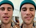 Những điều cần biết về hội chứng Ramsay Hunt đã khiến Justin Bieber liệt nửa mặt